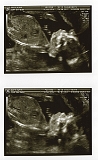 3rd Ultrasound 05